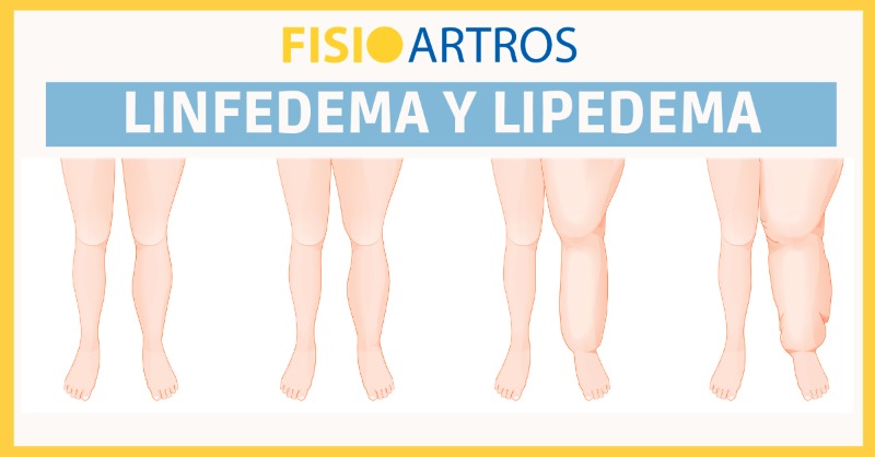 Linfedema-lipedema